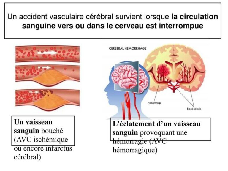 Accident Vasculaire Cérébral - Infirmier Pro