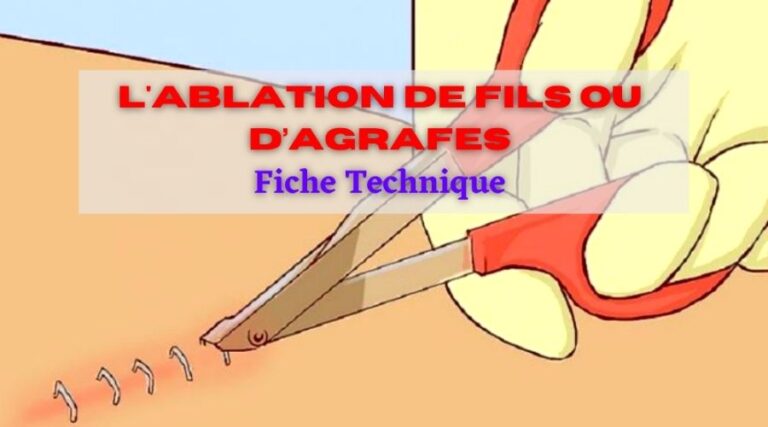 L'Ablation de fils ou d’agrafes Fiche Technique