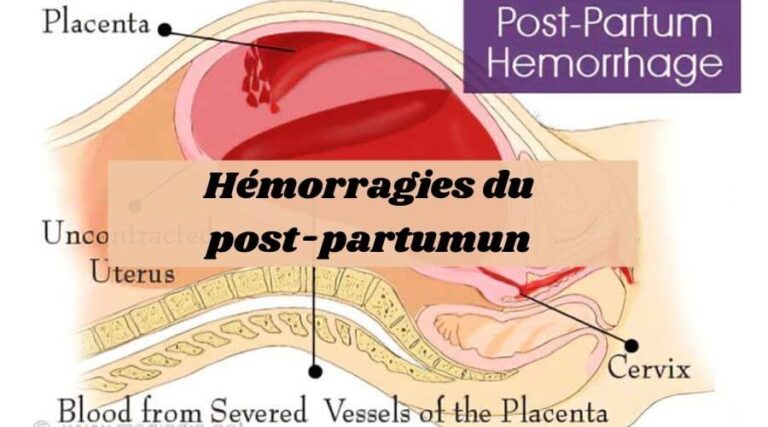 Hemorragies-du-post-partumun