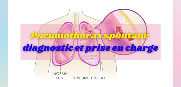 Pneumothorax spontané : diagnostic et prise en charge