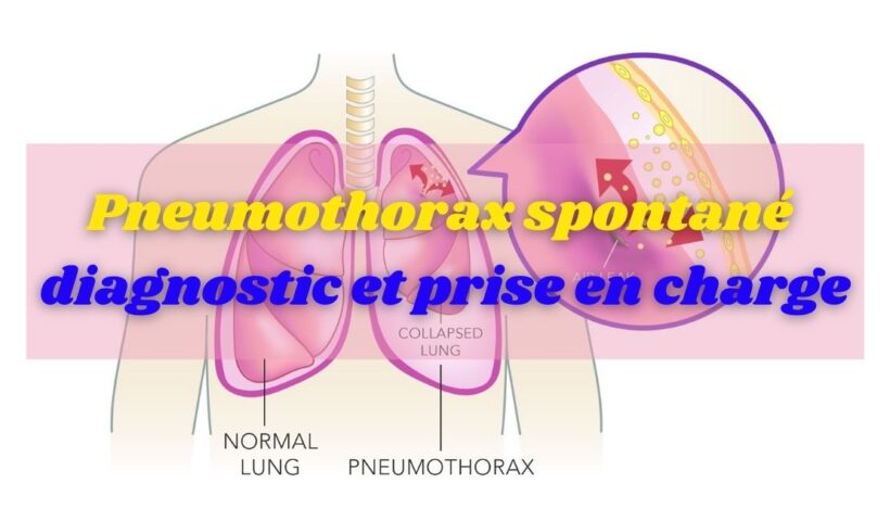Pneumothorax spontané : diagnostic et prise en charge
