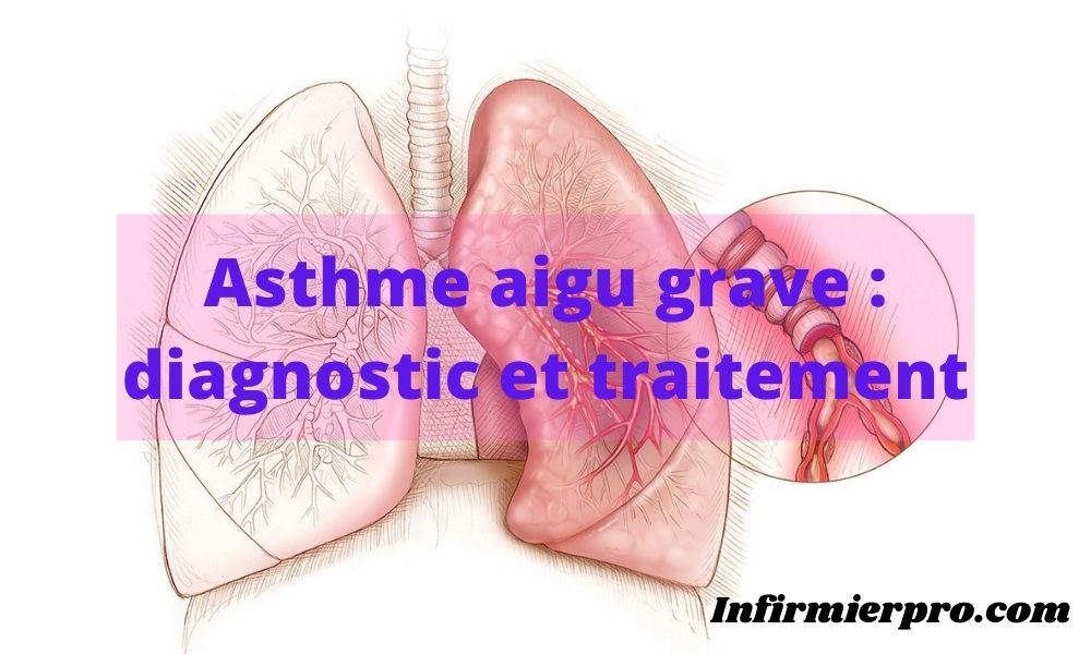 Asthme aigu grave diagnostic et traitement 