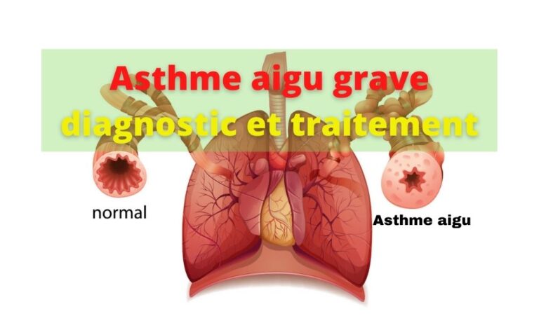 Asthme aigu grave : diagnostic et traitement