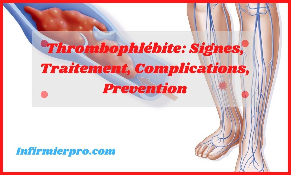 thrombophlebite-signes-traitement-complications-prevention