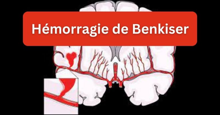 Hemorragie-de-Benkiser