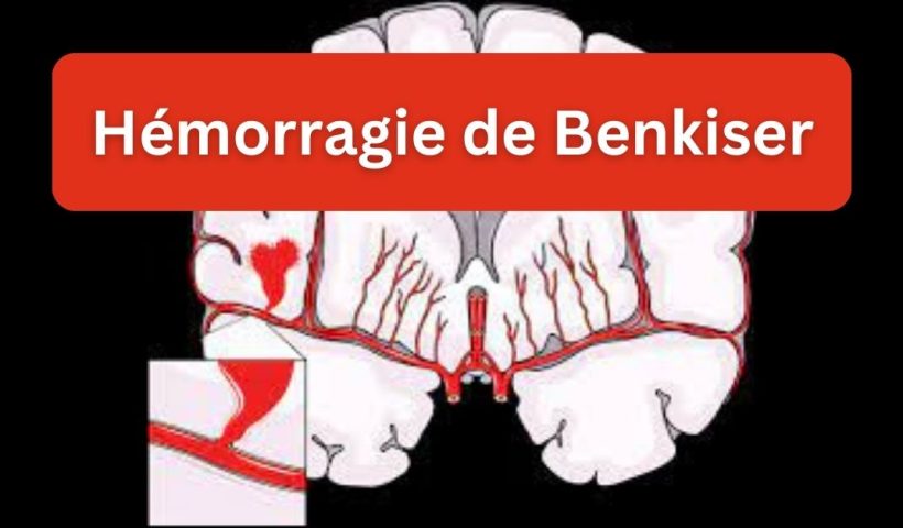 Hemorragie-de-Benkiser