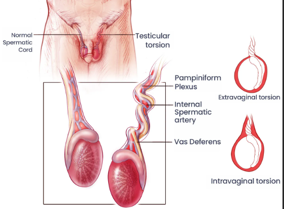 Diagnostic-de-la-torsion-testiculaire