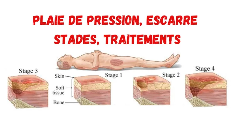 Plaie-de-Pression-Escarre-stades-traitements